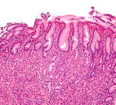 Gastristics treatment